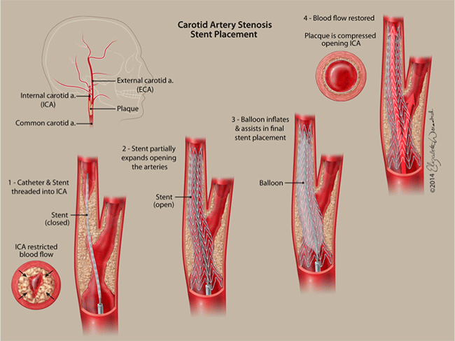 ica carotid-stenosis-stent-placement